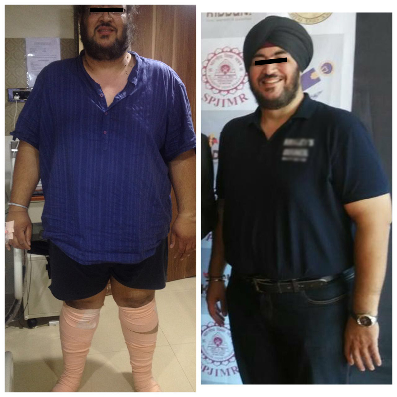 bypass surgery for weight loss mumbai
